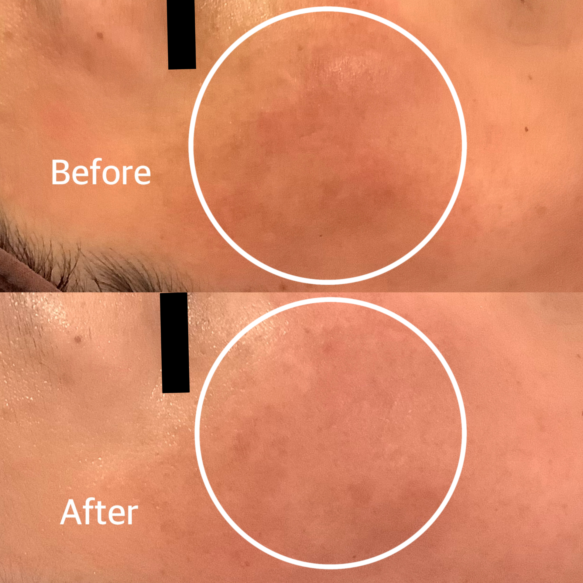 広島エステ　エステシミ取り